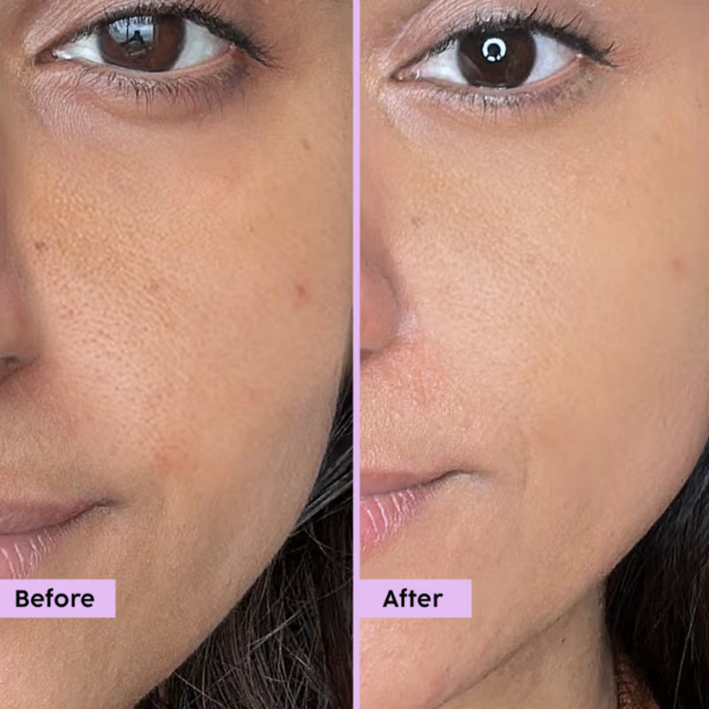 Plix Jamun Active Acne Regime With Cleanser & Toner To Unclog Pores & Reduce Acne