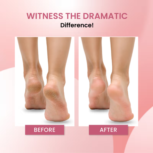 UrbanYog Electric Callus Remover