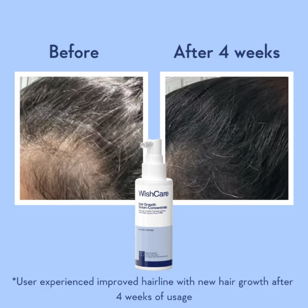 WishCare Hair Growth Serum Concentrate with Redensyl & Rosemary-In-Vivo Tested-Controls Hairfall