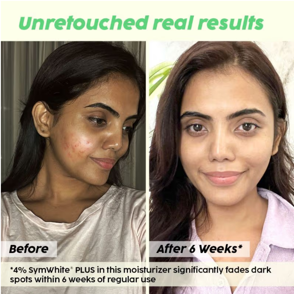Plix 2% Alpha Arbutin Pineapple Moisturizer With SymWhite PLUS For Hyperpigmentation & Dark Spots