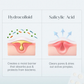 Seoulskin Acne Pimple Patch