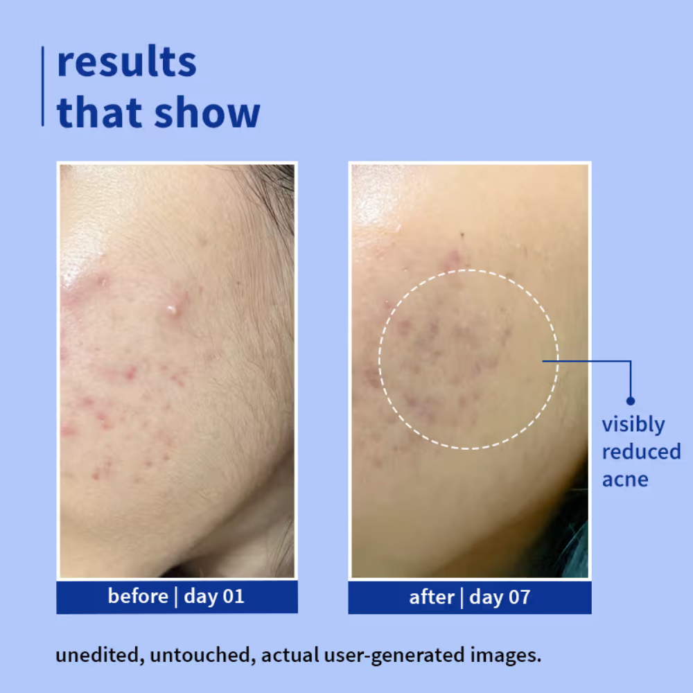 Plum 1% Salicylic Acid & Blueberry Clearly Gentle Gel Face Wash, For Acne Prone & Oily Skin
