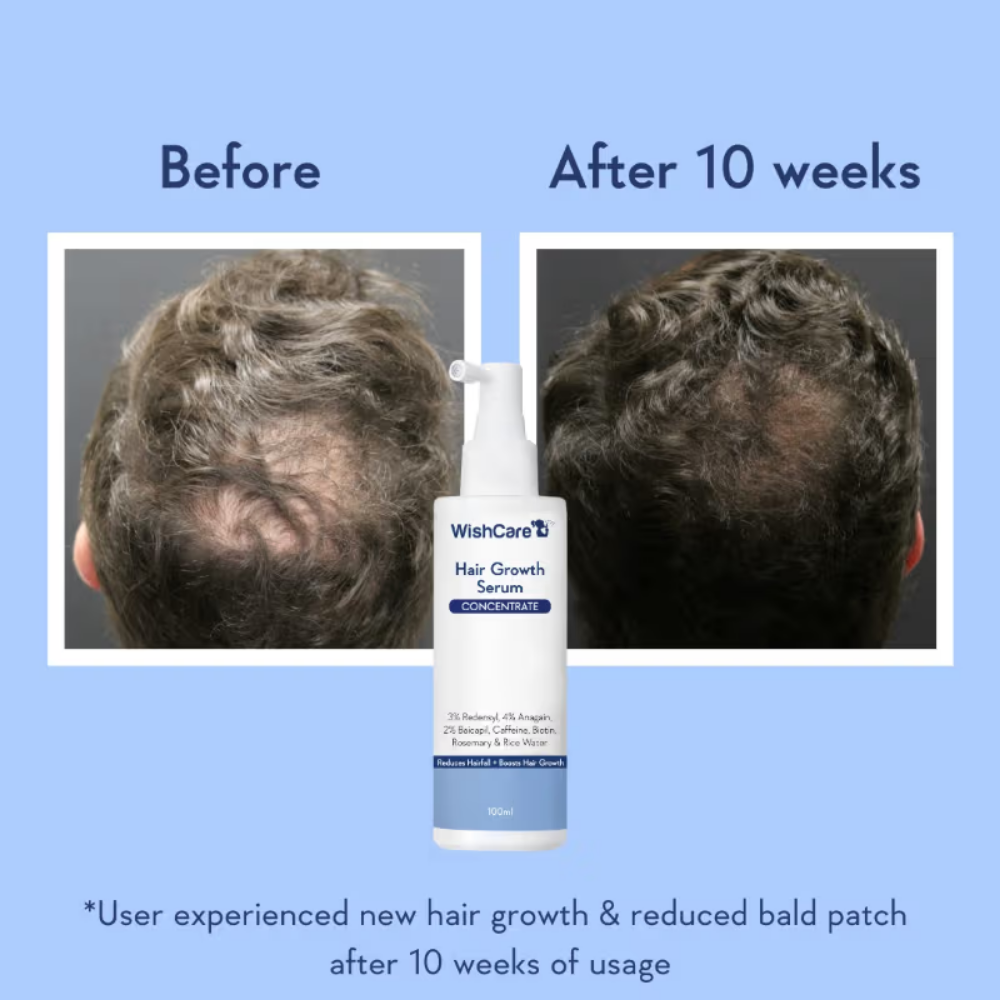 WishCare Hair Growth Serum Concentrate with Redensyl & Rosemary-In-Vivo Tested-Controls Hairfall