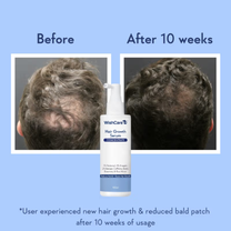 WishCare Hair Growth Serum Concentrate with Redensyl & Rosemary-In-Vivo Tested-Controls Hairfall