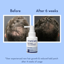 WishCare Hair Growth Serum Concentrate with Redensyl & Rosemary-In-Vivo Tested-Controls Hairfall