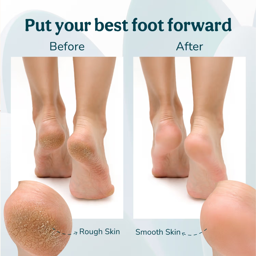 Caresmith Bloom Rechargeable Callus Remover for Feet Pedicure Machine