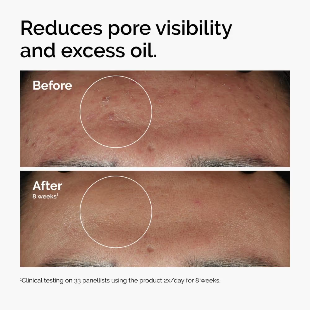 The Ordinary Niacinamide 10% + Zinc 1% High Strength