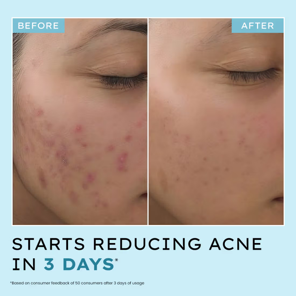 Hyphen Anti Acne 10% Azelaic Acid 2% Salicylic Acid Face Serum, Tea Tree Extract, Fades Acne Marks