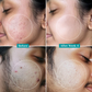 Pilgrim Salicylic & Glycolic Acid Anti Acne Serum