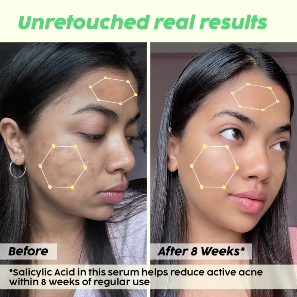 PLIX 2% Salicylic Acid Jamun Active Acne Control Dewy Serum for Active Acne & Dark Spot Reduction