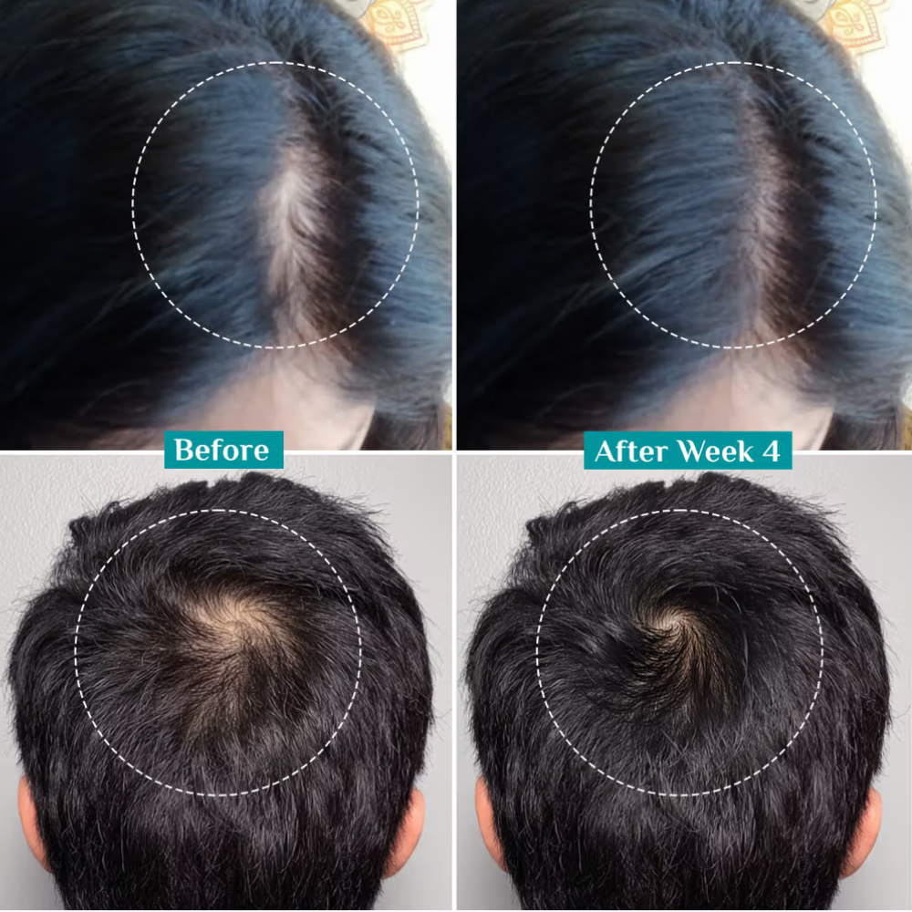 Pilgrim 3% Redensyl & 4% Anagain Advance Hair Growth Serum Roll-On With Rosemary & Korean Black Rice